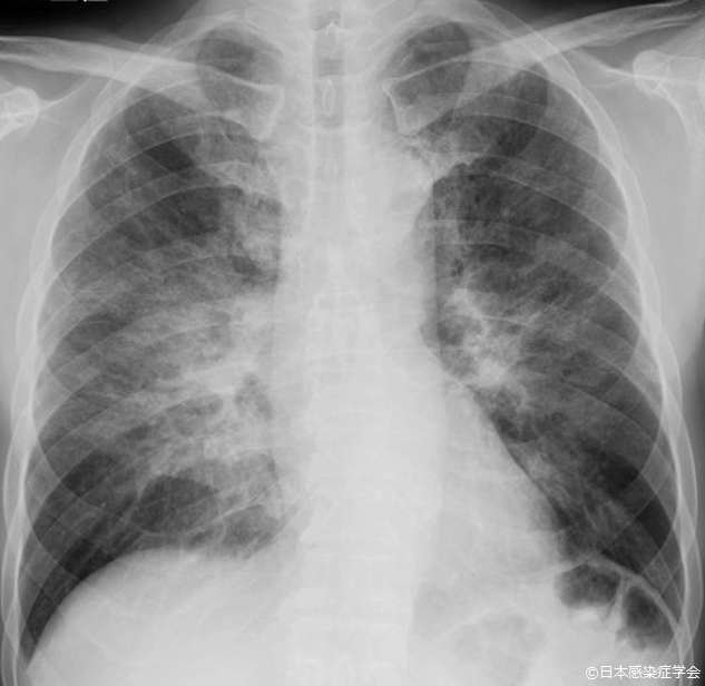 入院時胸部単純X線写真