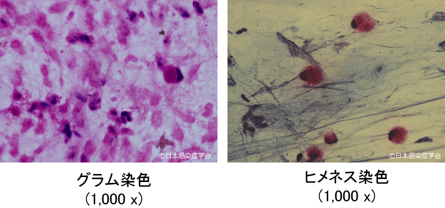 気管内洗浄検体 : 塗抹検査