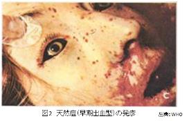 44              天然痘（smallpox）